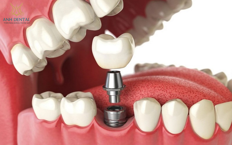 NHA KHOA THẨM MỸ ANH DENTAL - CHUYÊN TRỒNG RĂNG IMPLANT, NIỀNG RĂNG TRONG SUỐT, BỌC RĂNG SỨ UY TÍN