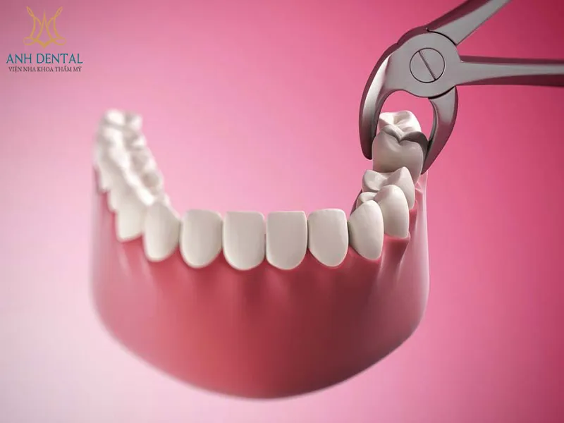 NHA KHOA THẨM MỸ ANH DENTAL - CHUYÊN TRỒNG RĂNG IMPLANT, NIỀNG RĂNG TRONG SUỐT, BỌC RĂNG SỨ UY TÍN