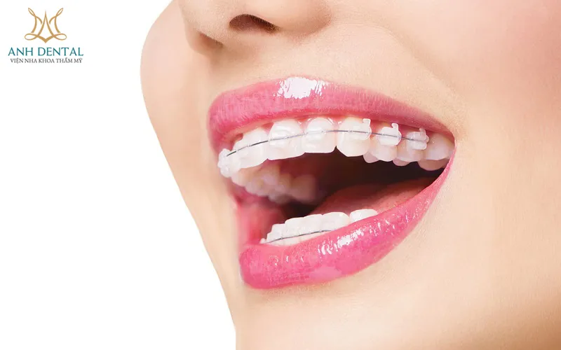 NHA KHOA THẨM MỸ ANH DENTAL - CHUYÊN TRỒNG RĂNG IMPLANT, NIỀNG RĂNG TRONG SUỐT, BỌC RĂNG SỨ UY TÍN