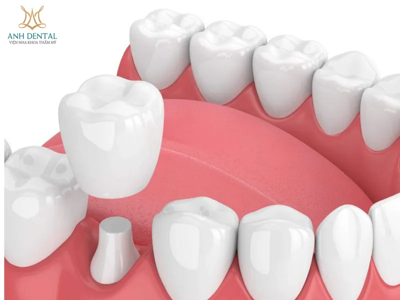 NHA KHOA THẨM MỸ ANH DENTAL - CHUYÊN TRỒNG RĂNG IMPLANT, NIỀNG RĂNG TRONG SUỐT, BỌC RĂNG SỨ UY TÍN
