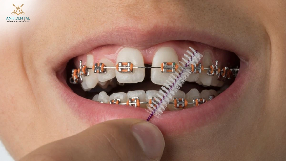 niềng răng bị hở kẽ