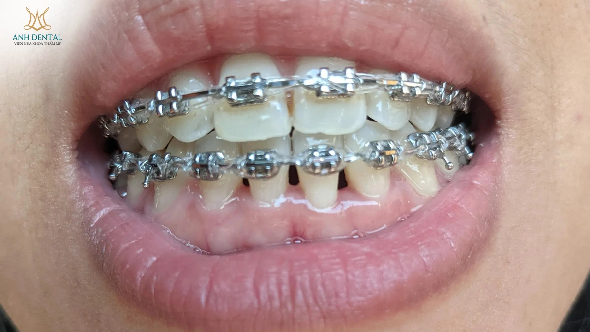 niềng răng bị hở kẽ