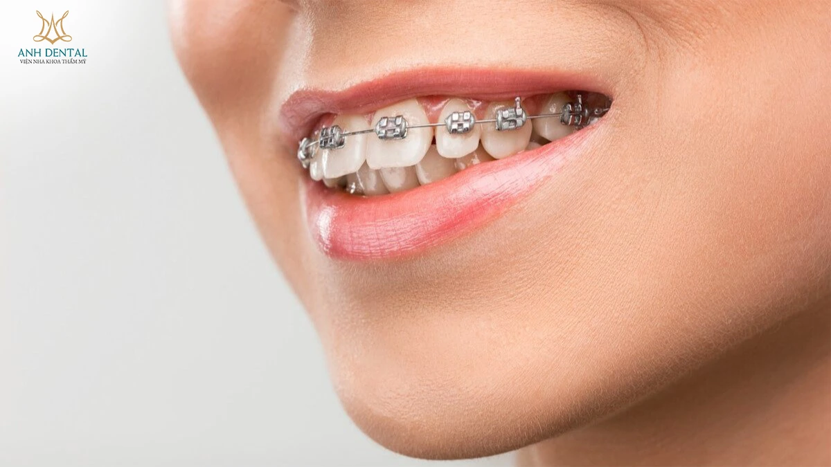 niềng răng bị hở kẽ