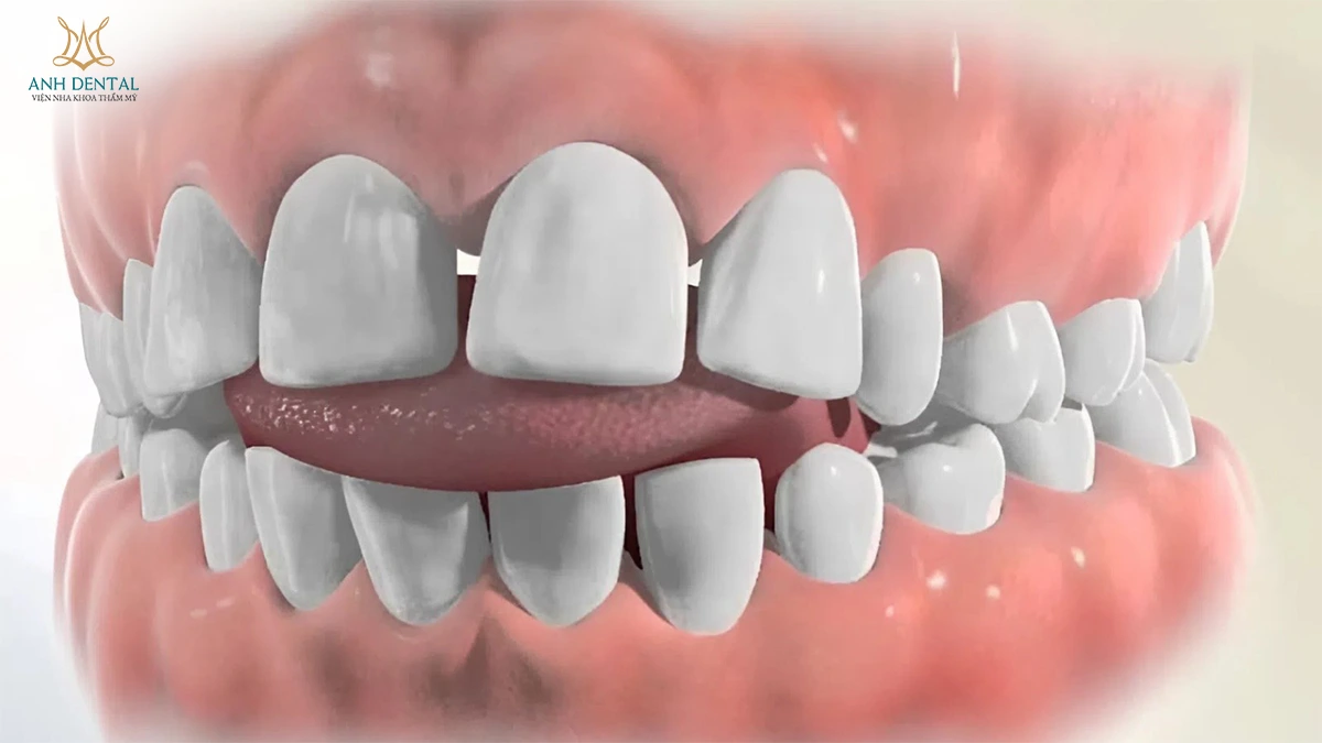 niềng răng bị hở kẽ