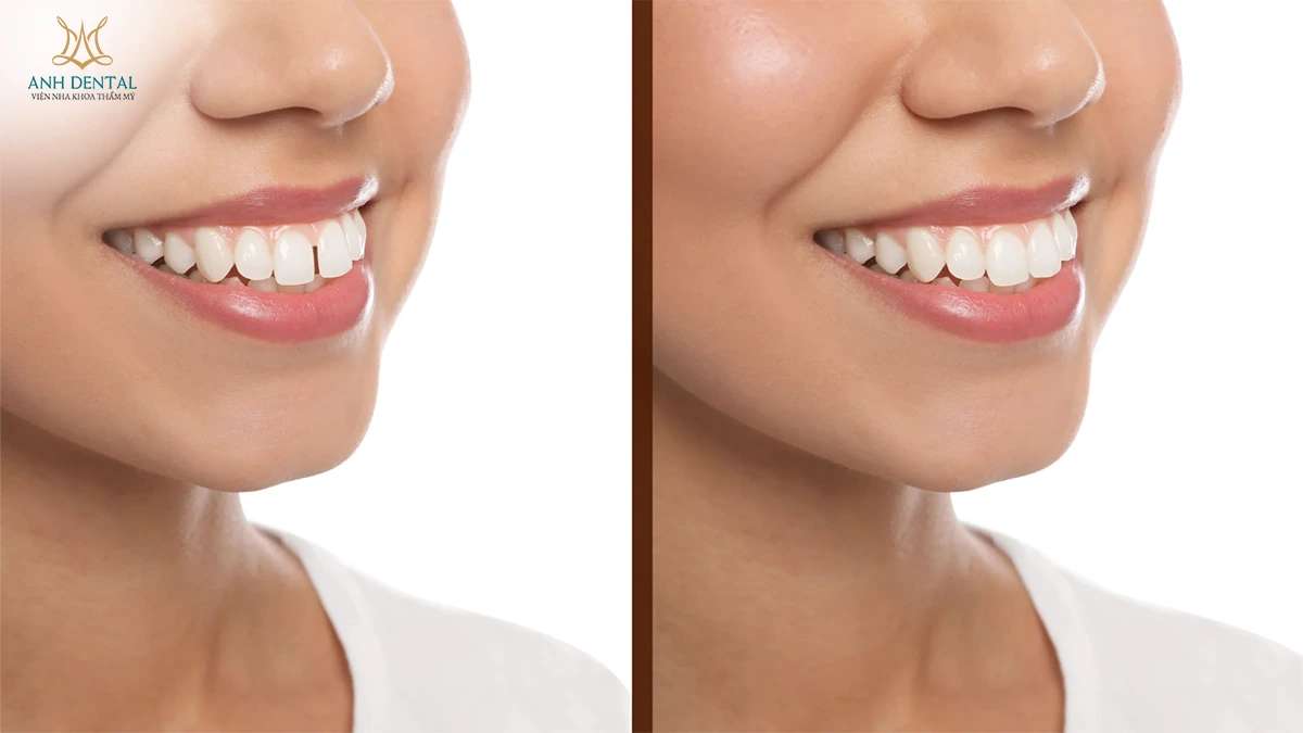 niềng răng bị hở kẽ