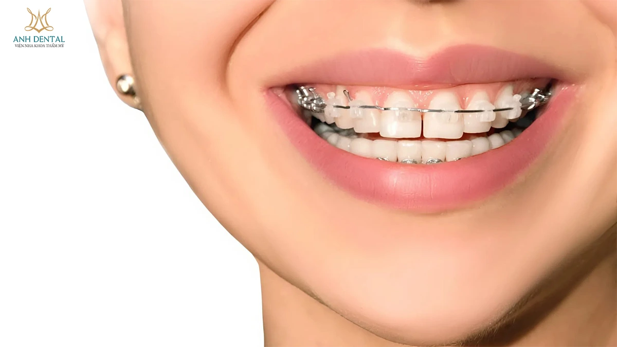 niềng răng bị hở kẽ