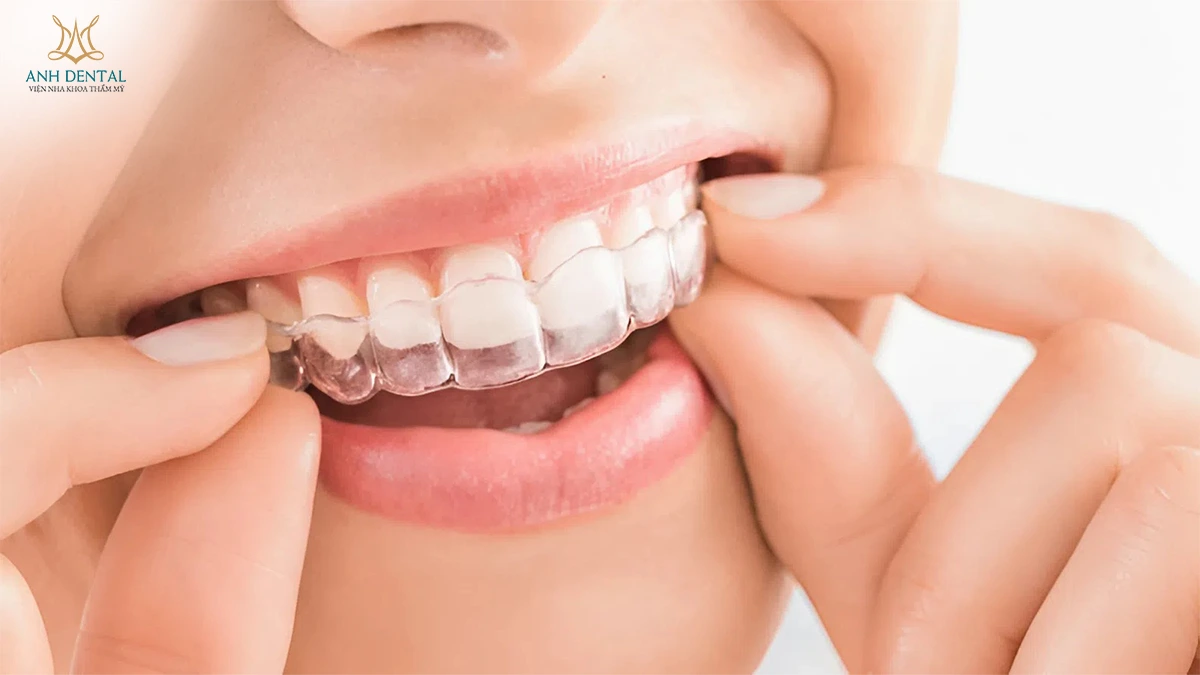 niềng răng bị hở kẽ