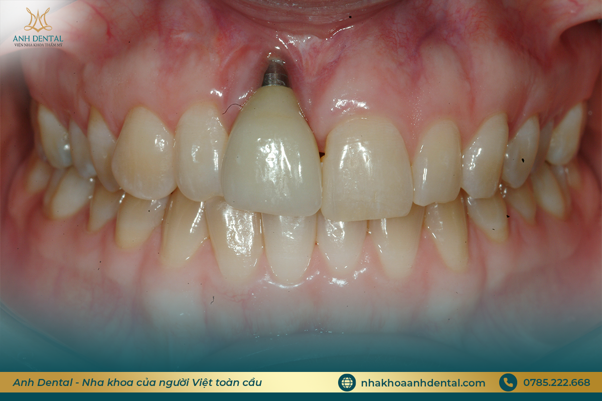 tác hại của việc trồng răng implant