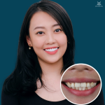 Bảng giá Bọc Răng Sứ tại Nha khoa Anh Dental 2025