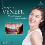 Bảng giá dán sứ Veneer của nha khoa thẩm mỹ Anh Dental 2025