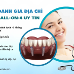 Giải pháp Implant All-On-4 giá rẻ: Giá tốt, hiệu quả và an toàn tại Anh Dental