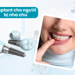 Giải pháp cấy ghép Implant cho người mắc bệnh nha chu