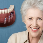 Implant cho người cao tuổi tại Anh Dental: Giải pháp sức khỏe răng miệng tối ưu