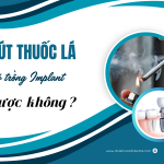 Có thể trồng răng Implant cho người hút thuốc lá? Cần lưu ý gì?