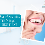 Trám răng cửa thưa - Giải pháp thẩm mỹ cho nụ cười hoàn hảo