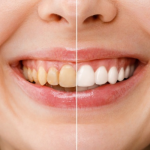 Trồng răng sứ có đau không? Nên trồng răng sứ loại nào tốt?