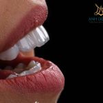 So sánh các loại vật liệu làm răng sứ phổ biến hiện nay: Ưu và nhược điểm từng loại