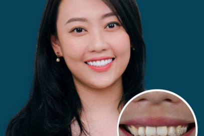 Bảng giá Bọc Răng Sứ tại Nha khoa Anh Dental 2025
