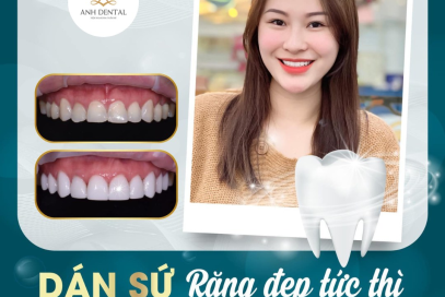 Dịch vụ Dán sứ Veneer