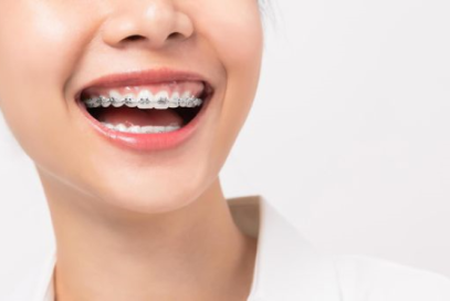 Dịch vụ niềng răng một hàm