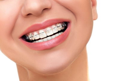 Dịch vụ Niềng răng thẩm mỹ