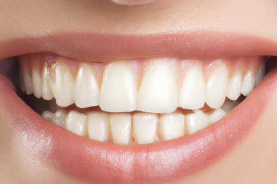 Cách điều trị cười hở lợi hiệu quả: tại nhà, không phẫu thuật và phẫu thuật