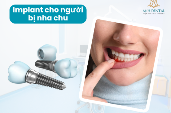 Giải pháp cấy ghép Implant cho người mắc bệnh nha chu