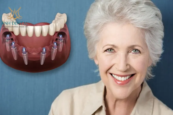 Implant cho người cao tuổi tại Anh Dental: Giải pháp sức khỏe răng miệng tối ưu