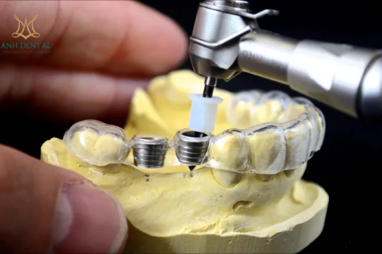 Viện Nha Khoa Thẩm Mỹ Anh Dental - Trung tâm Implant nha khoa không đau an toàn, hiệu quả