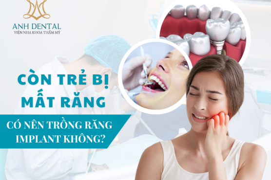 Implant cho người trẻ tuổi: Tại sao và khi nào nên trồng răng Implant?