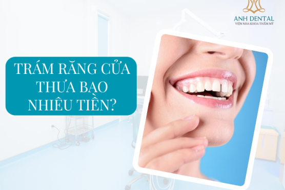 Trám răng cửa thưa - Giải pháp thẩm mỹ cho nụ cười hoàn hảo