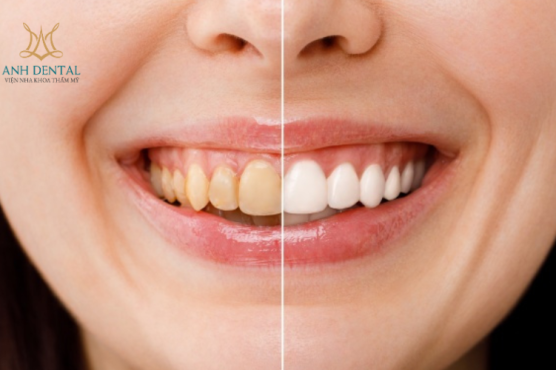 Trồng răng sứ có đau không? Nên trồng răng sứ loại nào tốt?