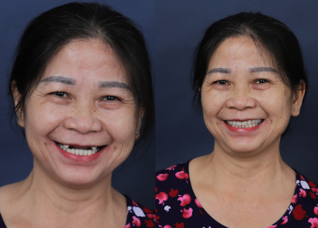 Cô Liên 60 tuổi - Cấy ghép Implant toàn hàm