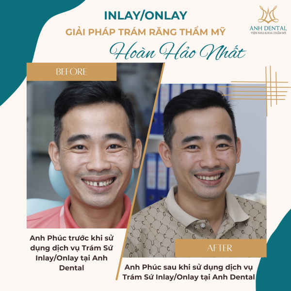 trám răng cửa thưa