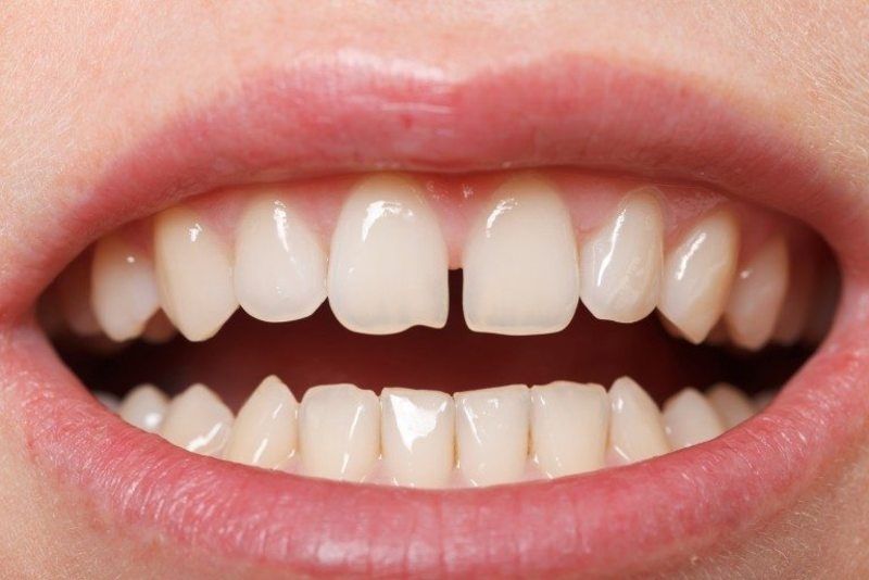 trám răng cửa thưa