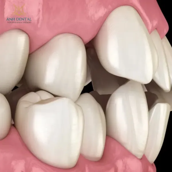 18 tuổi niềng răng bao lâu