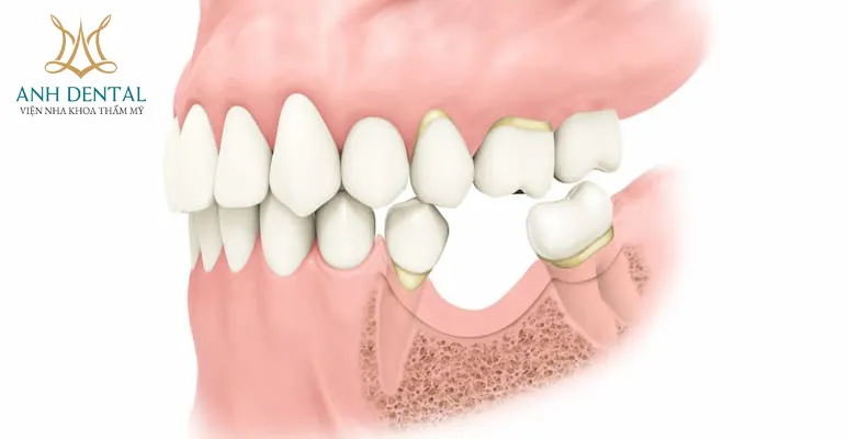 Quy trình kỹ thuật ghép xương tự thân