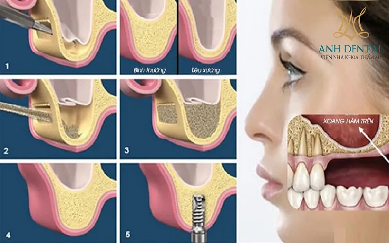 Quy trình kỹ thuật ghép xương tự thân