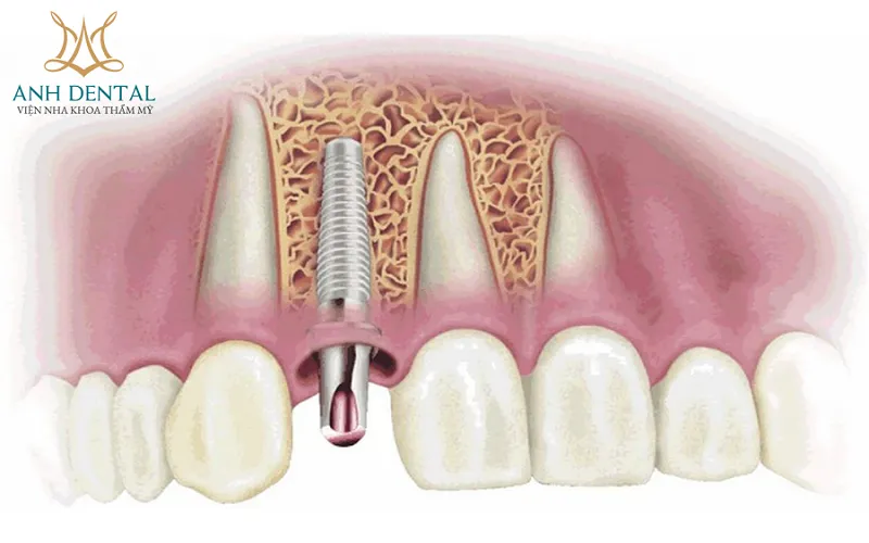 Quy trình kỹ thuật ghép xương tự thân