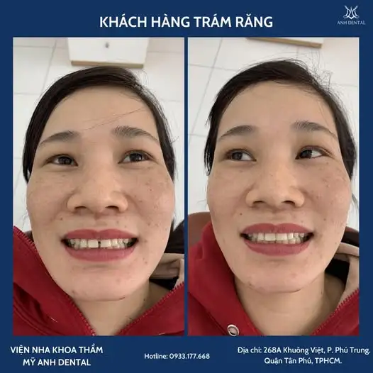Tác hại của việc trám răng
