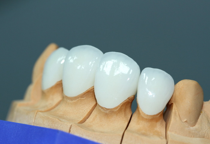 vật liệu làm răng sứ