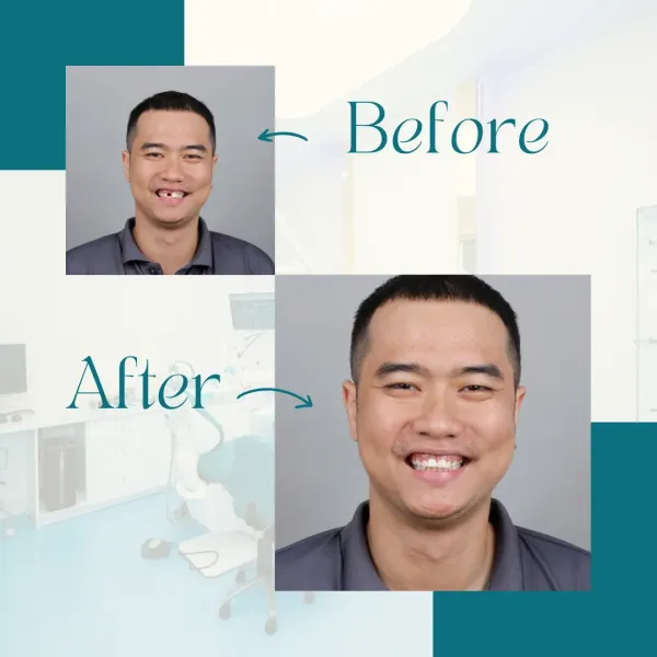 implant thẩm mỹ tự nhiên