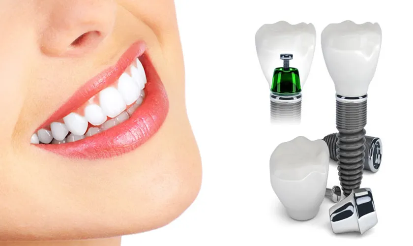 implant thẩm mỹ tự nhiên