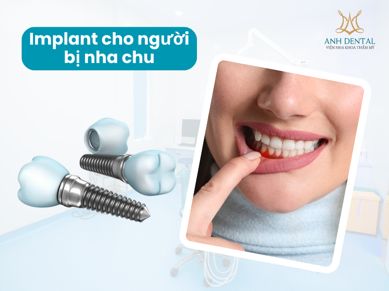 Implant cho người bị nha chu