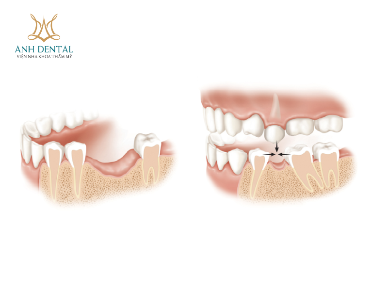 Implant cho người bị nha chu
