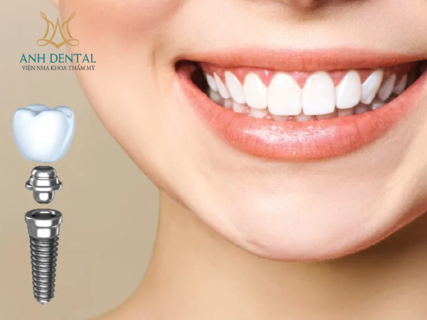 Implant cho người trẻ tuổi
