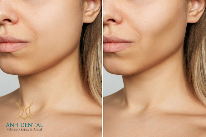 Implant cho người trẻ tuổi