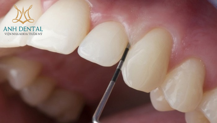 Implant cho người trẻ tuổi