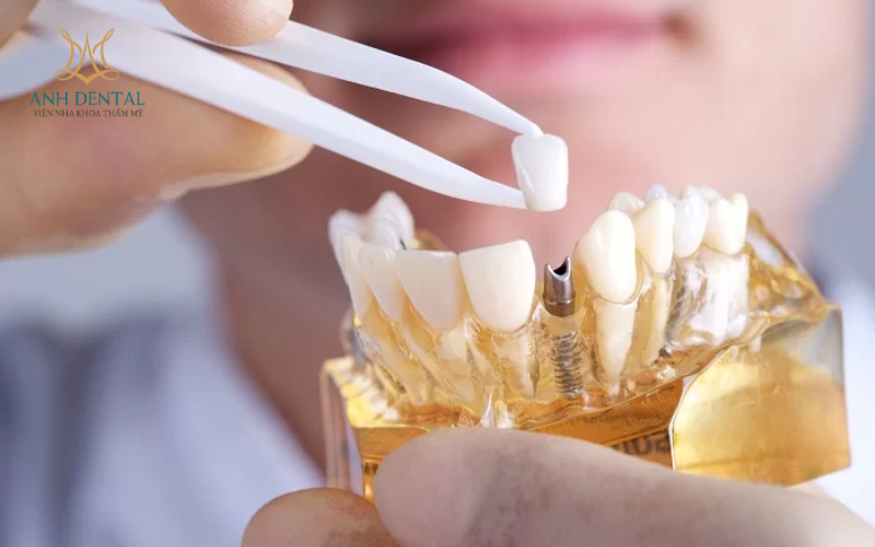 trồng răng sứ có đau không