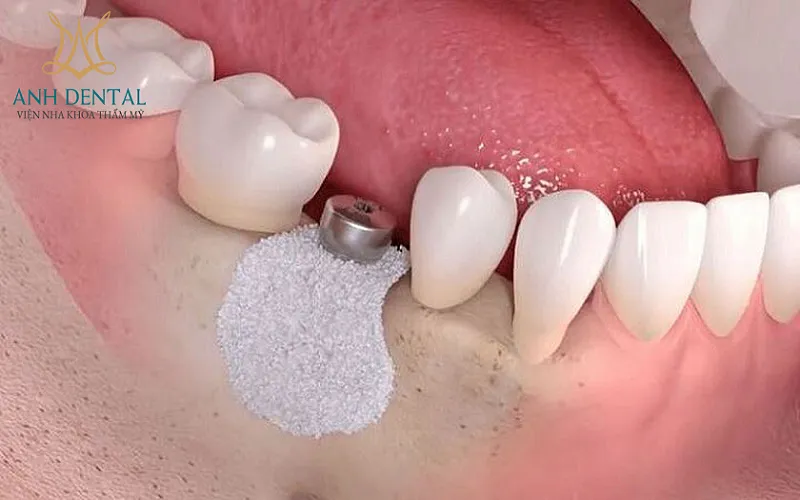 ghép xương tự thân có đau không